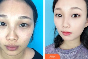 咸寧安美醫(yī)療美容門診部鄒紅整形價格表附激光美膚激光案例展示