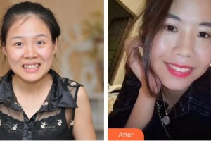 咸寧民生中山口腔醫(yī)院潘小青整形價格表附自鎖托槽矯正案例展示