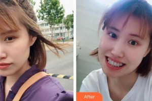 咸寧市第一人民醫(yī)院口腔科吳細霞整形價格表附金屬托槽矯正案例展示