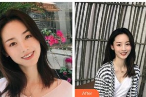 咸寧市第一人民醫(yī)院口腔科何小林整形價格表附金屬托槽矯正案例展示