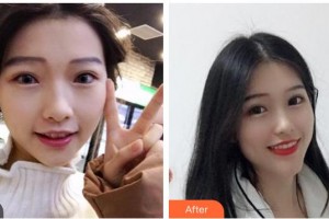 咸寧民生中山口腔醫(yī)院畢云昌整形價格表附牙齒隱形矯正案例展示