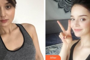 孝感華美醫(yī)療美容門(mén)診部王志軍整形價(jià)格表附埋線提升案例展示