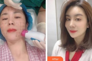 孝感仁愛(ài)醫(yī)院美容整形中心王悅整形價(jià)格表附熱瑪吉案例展示