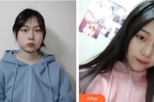 孝感現(xiàn)代儷人醫(yī)院整形科王婷整形價(jià)格表附埋線提升案例展示