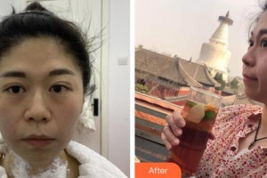 孝感歐陽(yáng)整形美容診所王珺整形價(jià)格表附熱瑪吉案例展示