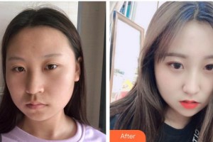 孝感歐陽(yáng)整形美容診所劉琳整形價(jià)格表附埋線提升案例展示