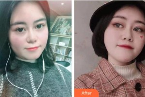 孝感歐陽(yáng)整形美容診所嚴(yán)飛整形價(jià)格表附埋線提升案例展示