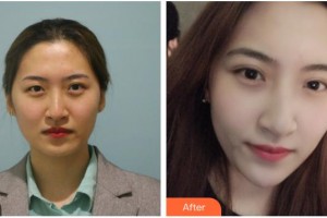 孝感愛(ài)爾眼科醫(yī)院桂芬整形價(jià)格表附埋線雙眼皮案例展示