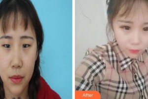 孝感愛(ài)爾眼科醫(yī)院胡寶珍整形價(jià)格表附切開(kāi)雙眼皮案例展示