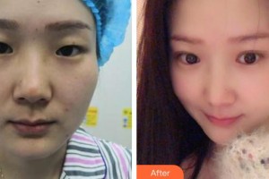 孝感愛(ài)爾眼科醫(yī)院熊煒整形價(jià)格表附眼部綜合案例展示