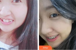 孝感君雅口腔門診胡禮明整形價(jià)格表附牙齒隱形矯正案例展示