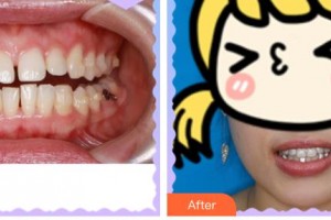 孝感現(xiàn)代儷人醫(yī)院整形科付錦芳整形價(jià)格表附牙齒隱形矯正案例展示