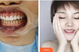 鄂州中山口腔醫(yī)院葛麗娟整形價格表附美白貼片案例展示