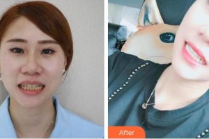 鄂州中山口腔醫(yī)院梁智整形價格表附美白劑美白牙齒案例展示