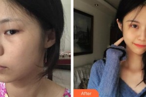 鄂州愛爾眼科醫(yī)院張杰整形價格表附眼部綜合案例展示