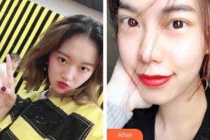 鄂州愛爾眼科醫(yī)院胡悅整形價格表附切開雙眼皮案例展示