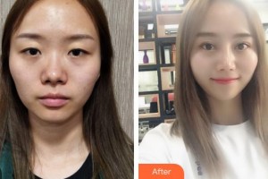 鄂州愛爾眼科醫(yī)院楊亞利整形價格表附上眼瞼去脂案例展示