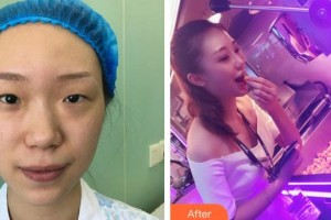 武漢兒童醫(yī)院李世蓮整形價格表附切開雙眼皮案例展示
