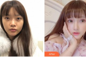 武漢兒童醫(yī)院向施紅整形價格表附開內(nèi)眼角案例展示