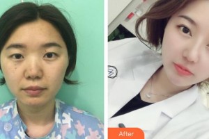 武漢市第八醫(yī)院眼科黃昭昭整形價格表附眼部綜合案例展示