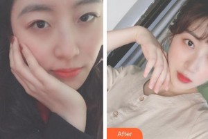 武漢艾格眼科醫(yī)院彭華琮整形價格表附眼部綜合案例展示