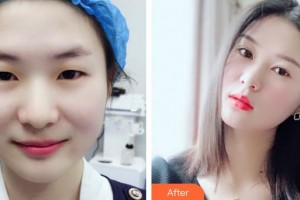 武漢艾格眼科醫(yī)院程勉征整形價格表附眼部綜合案例展示