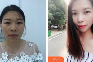 武漢艾格眼科醫(yī)院周雄整形價格表附切開雙眼皮案例展示