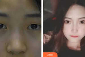 武漢艾格眼科醫(yī)院張捷整形價格表附定點雙眼皮案例展示