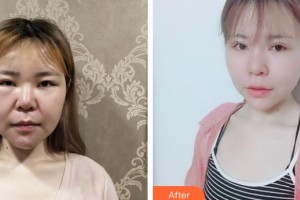 武漢艾格眼科醫(yī)院陳雅瓊整形價格表附切開雙眼皮案例展示