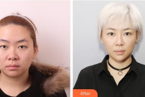 武漢艾格眼科醫(yī)院彭志華整形價(jià)格表附切開(kāi)雙眼皮案例展示