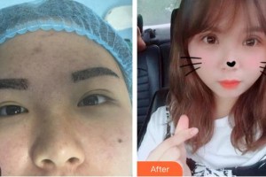 武漢艾格眼科醫(yī)院段淯平整形價(jià)格表附切開(kāi)雙眼皮案例展示