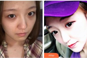 武漢艾格眼科醫(yī)院劉新榮整形價(jià)格表附開(kāi)外眼角案例展示