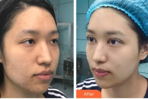 武漢艾格眼科醫(yī)院賀寧整形價(jià)格表附切開(kāi)雙眼皮案例展示