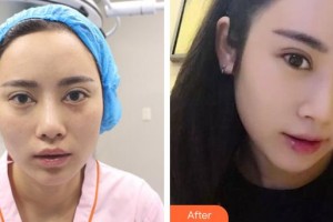 武漢艾格眼科醫(yī)院趙霞整形價格表附眼部綜合案例展示