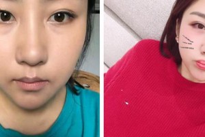 武漢艾格眼科醫(yī)院許澤駿整形價格表附眼部綜合案例展示