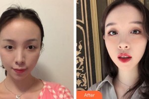 武漢艾格眼科醫(yī)院整形價(jià)格表附眼部綜合案例展示