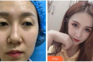 武漢艾格眼科醫(yī)院張琪整形價(jià)格表附眼部綜合案例展示