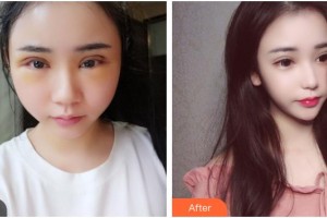 武漢艾格眼科醫(yī)院楊蕾整形價(jià)格表附切開雙眼皮案例展示