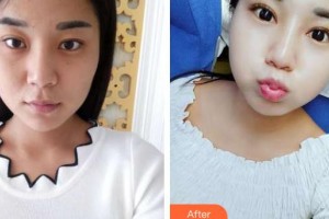 武漢艾格眼科醫(yī)院沈錦霞整形價(jià)格表附眼部綜合案例展示