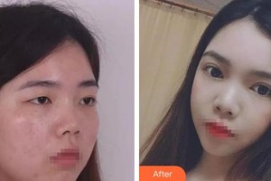 武漢艾格眼科醫(yī)院高金濤整形價(jià)格表附眼部綜合案例展示