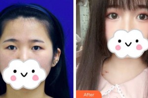 武漢艾格眼科醫(yī)院劉宗萬整形價(jià)格表附眼部綜合案例展示