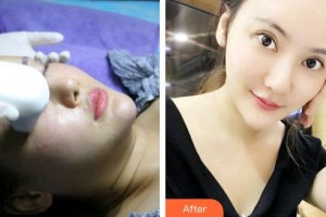 武漢艾格眼科醫(yī)院彭毅整形價(jià)格表附激光去眼袋案例展示