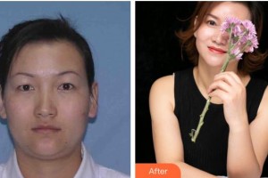 武漢艾格眼科醫(yī)院偉整形價(jià)格表附眼部綜合案例展示