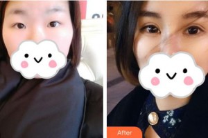 武漢艾格眼科醫(yī)院李愛民整形價(jià)格表附眼部綜合案例展示