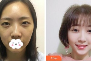 武漢艾格眼科醫(yī)院劉艷春整形價(jià)格表附切開雙眼皮案例展示