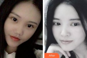 武漢佰視達(dá)眼科門診部林可劼整形價(jià)格表附切開雙眼皮案例展示