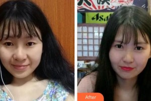 武漢佰視達(dá)眼科門診部張鑫整形價(jià)格表附切開雙眼皮案例展示