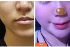 黃石美亞醫(yī)療美容門診部黃志鵬整形價(jià)格表附埋線提升案例展示