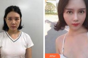 黃石市第五醫(yī)院整形外科韓斌整形價(jià)格表附熱瑪吉案例展示