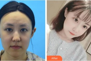 黃石市中心醫(yī)院整形外科王政祥整形價(jià)格表附埋線提升案例展示